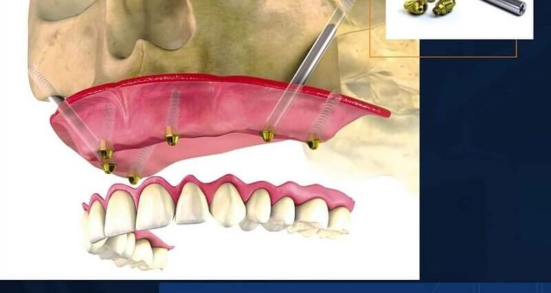 Masz problem z niekomfortową protezą zębową? 2 Leczenie implantami zygomatycznymi